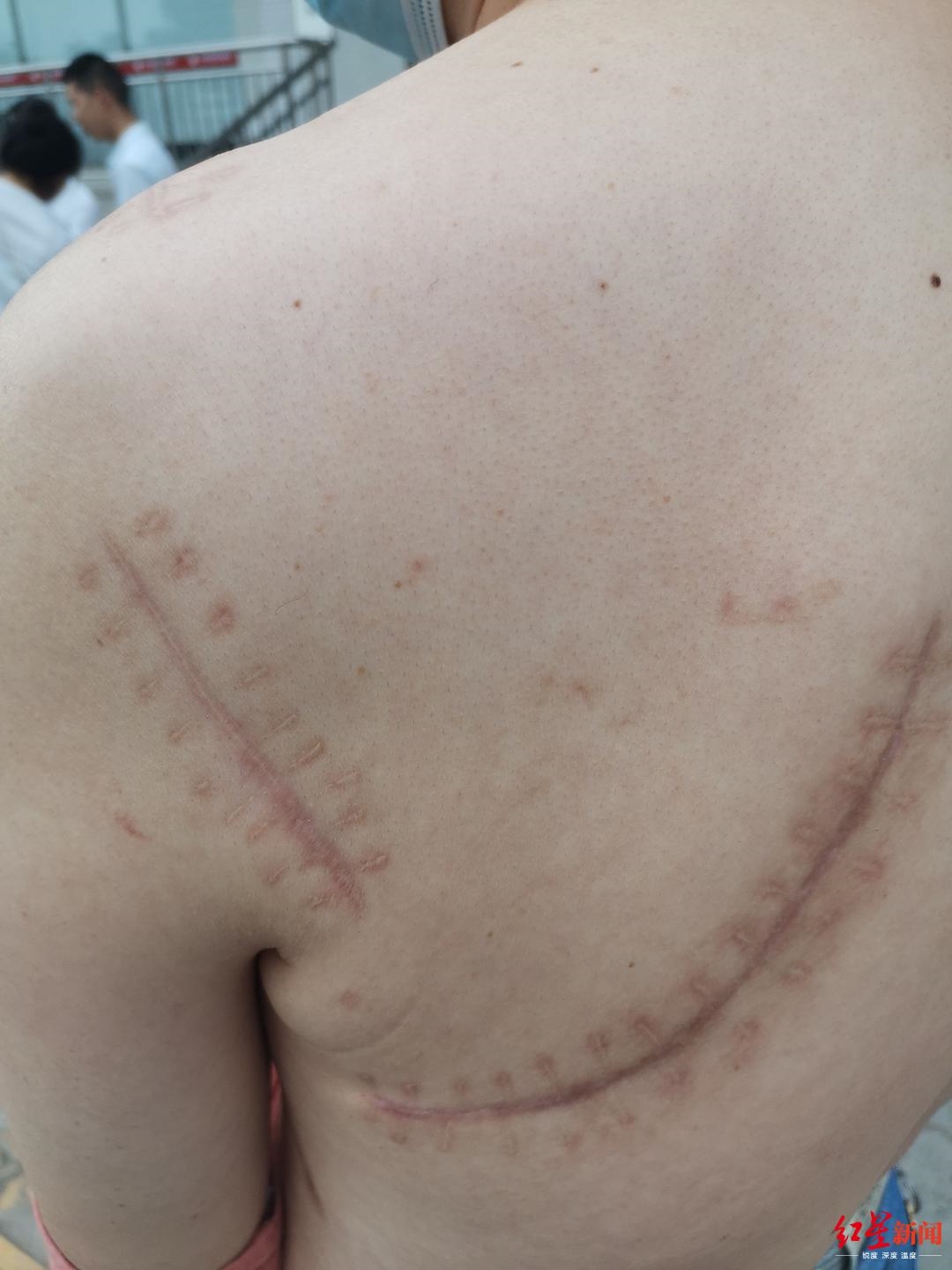 钟科展示身上的伤疤